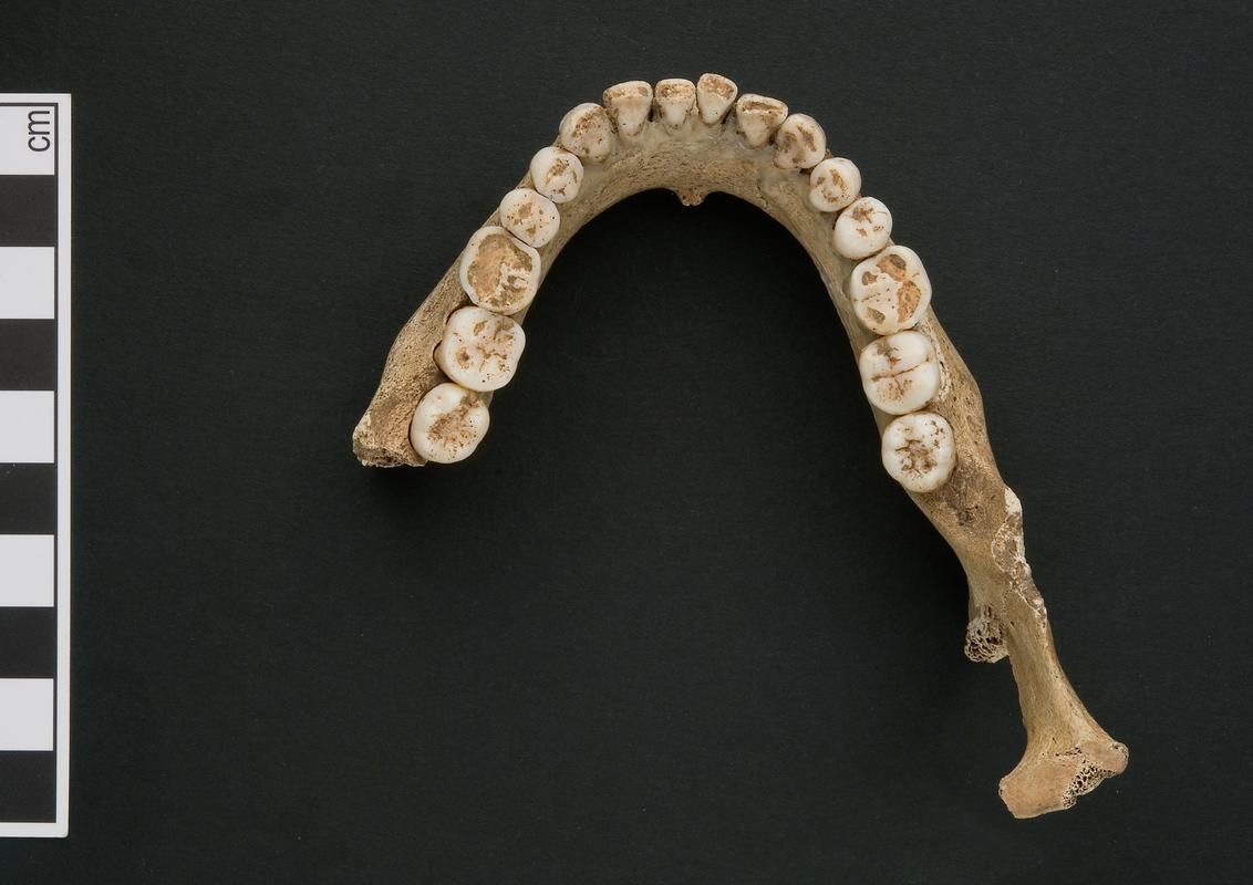 Lower right molar - human