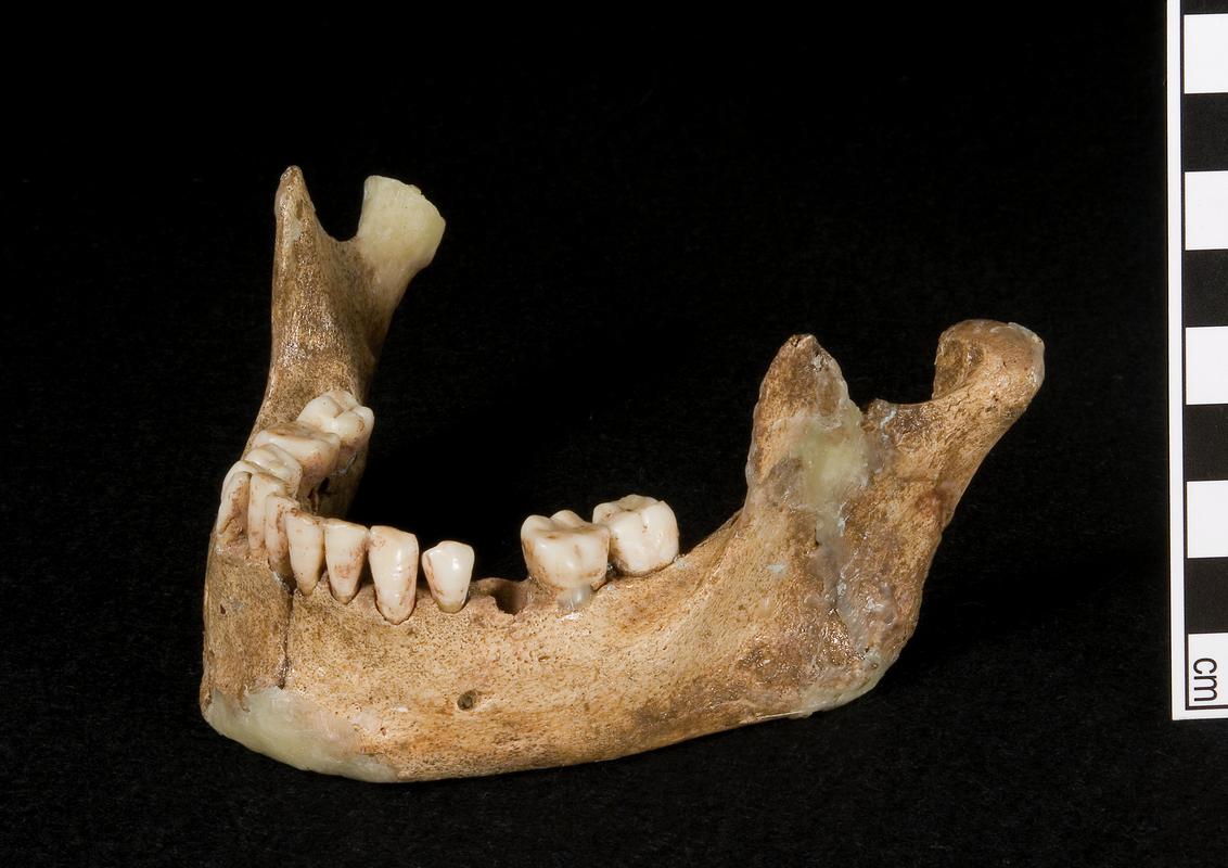 Early Medieval human remains