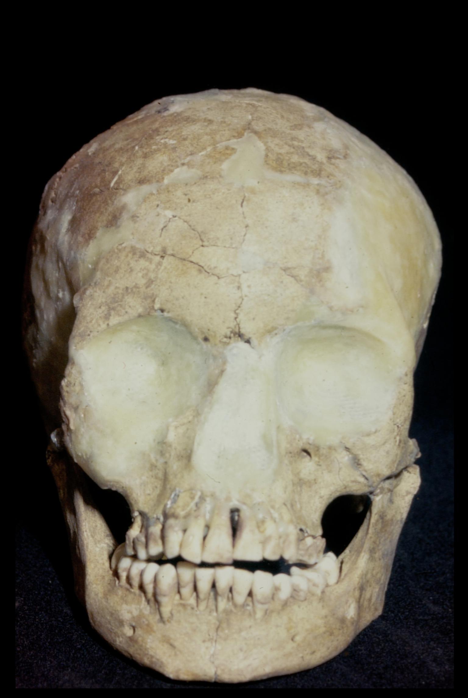 Early Medieval human skull