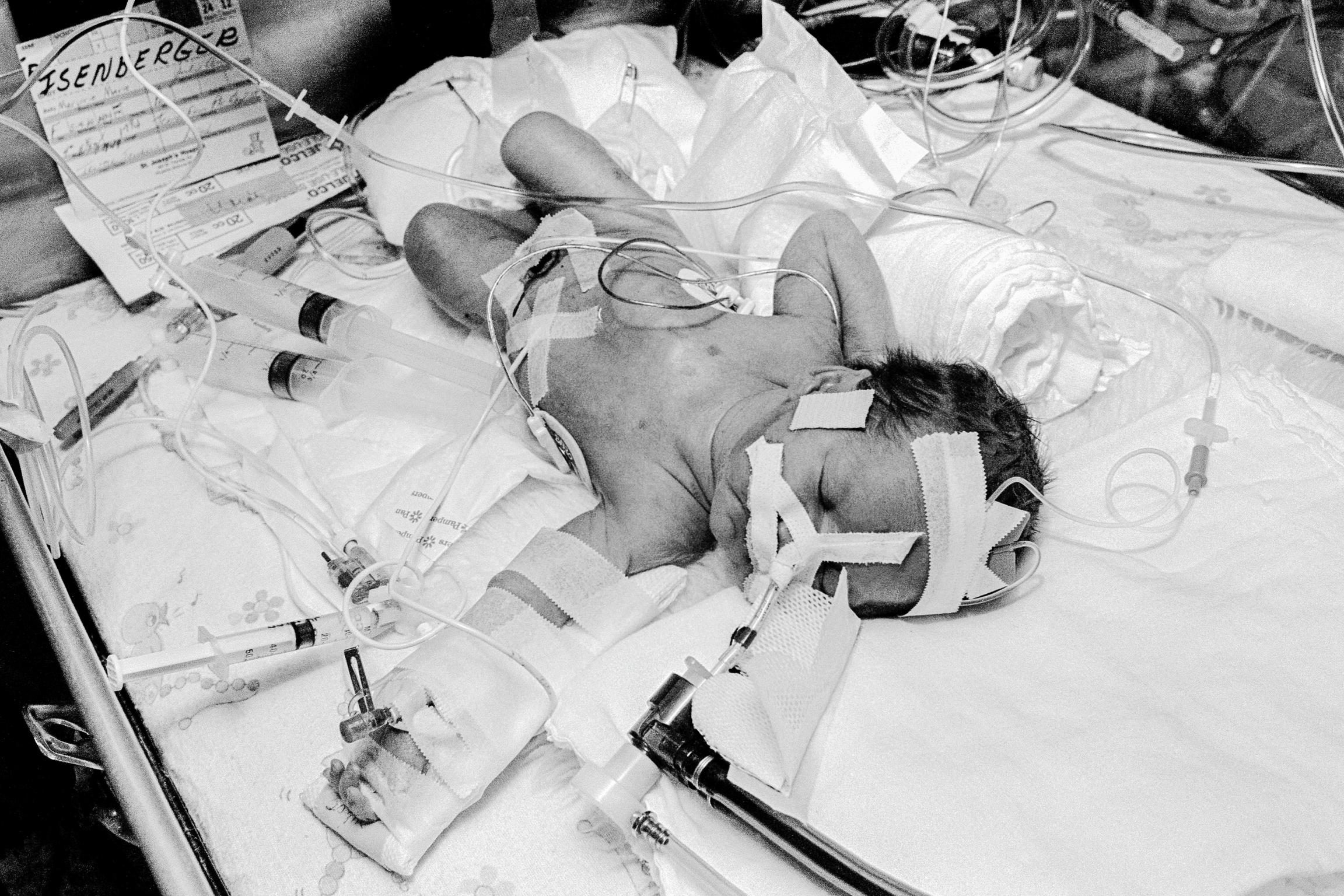 Preemie Baby unit at St Joseph's Hospital. I.C.U. Center. Showing endo-tracteal tube, umbilical catheter, electrode, and temperature probe. Phoenix, Arizona USA