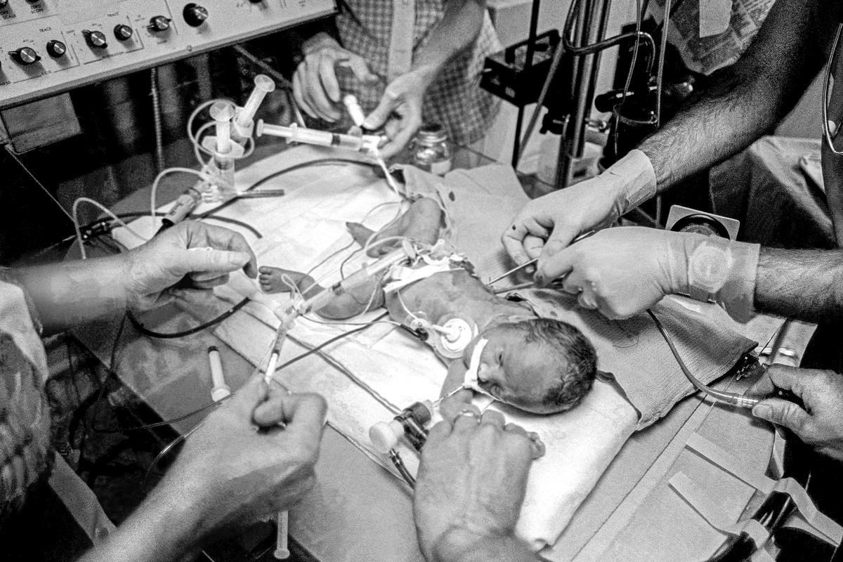 Preemie Baby unit at St Joseph&#039;s Hospital. Preemie baby within minutes of birth in the I.C.U. Shown are an Endo-tracheal tube, an umbilical catheter, a chest tube being inserted and an electrode.