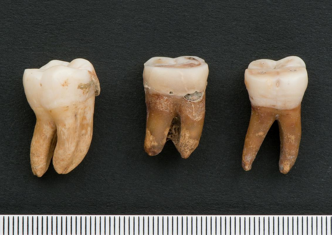 Right and left upper second molars - human