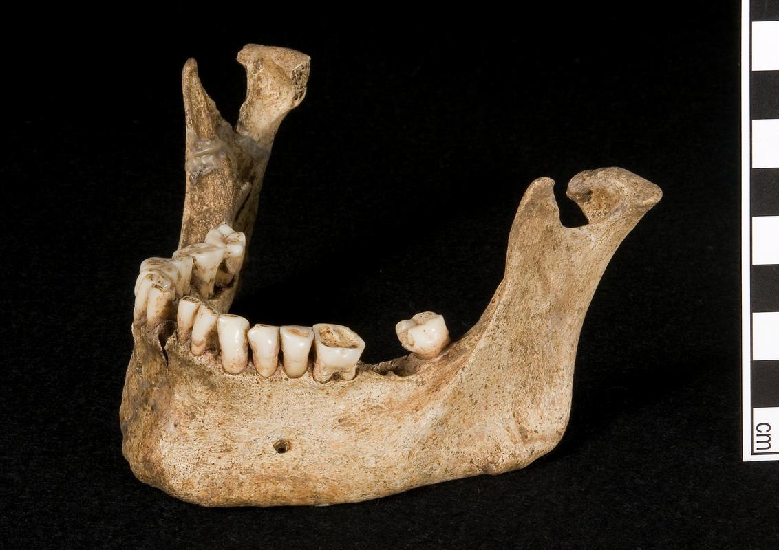 Early Medieval human remains