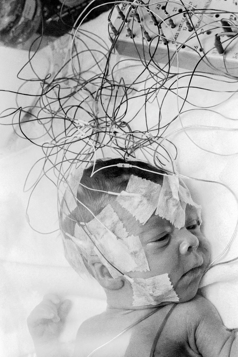 E.E.G on preemie baby. Done to see why the baby was having seizures and intraventicular hemmoraha. Phoenix, Arizona USA