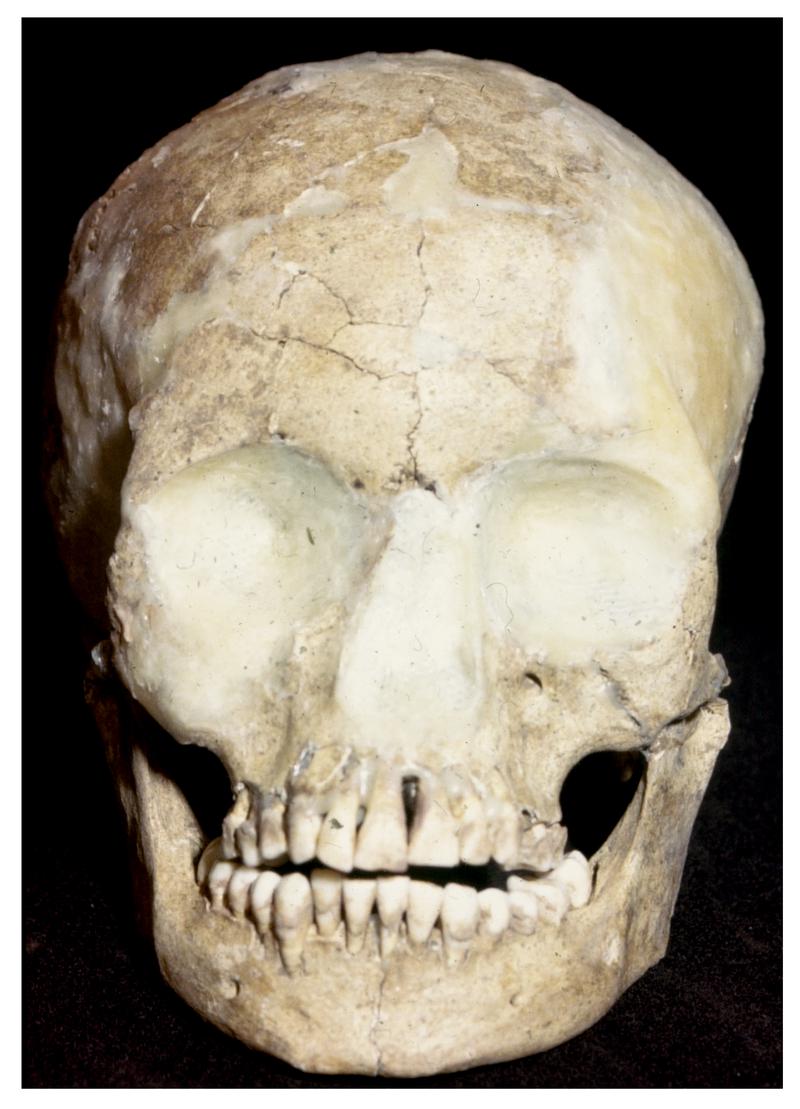 Glyn, Llanbedrgoch skull burial 4