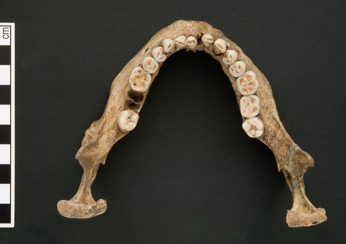 Lower right molar - human