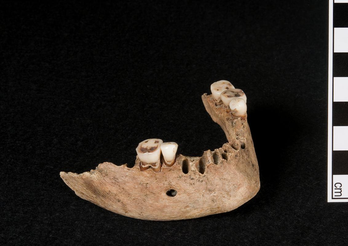 Early Medieval human remains
