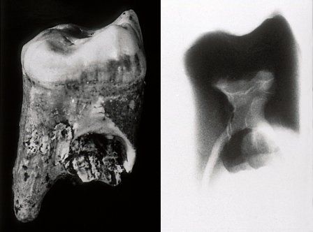 Neanderthal Man tooth x-ray